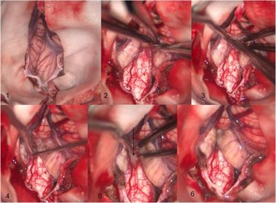 Clinical analysis of atlanto-occipital decompression in the management of chiari malformation with multi-segmental syringomyelia